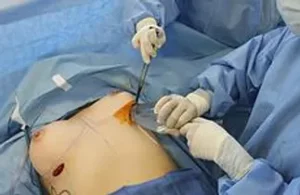 Dr. Diaz inserting the implant using the Keller Funnel