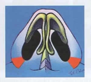 The nostrils are reduced using an alar base/ wedge resection