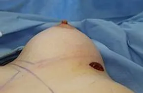 breast immediately after the implant is inserted