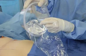 breast implant being immediately placed into the Keller Funnel