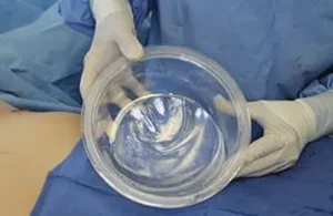 breast implant package immediately after it has been opened