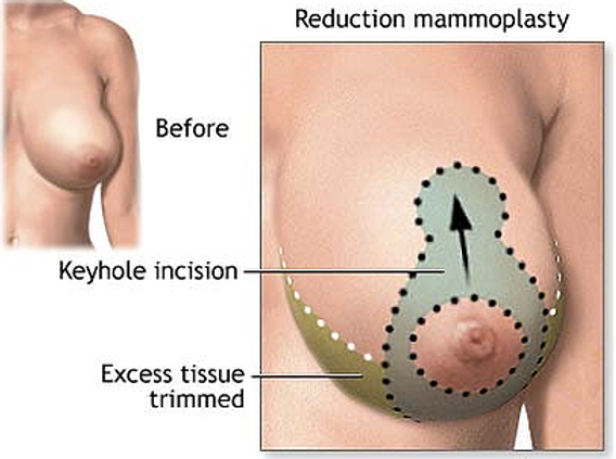 breast reduction excess tissue trimmed diagram