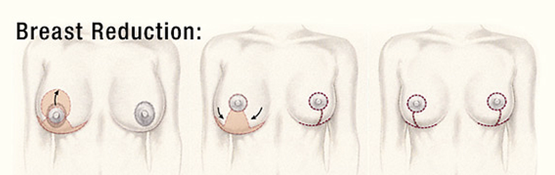 breast reduction surgery steps
