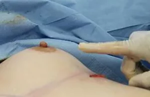 no blood in breast pocket during breast revision 2