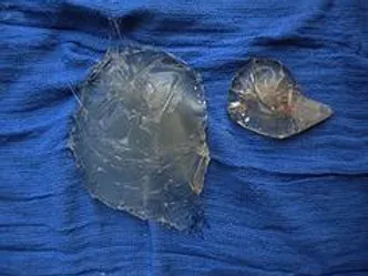 ruptured-silicone-implant-capsular-contracture