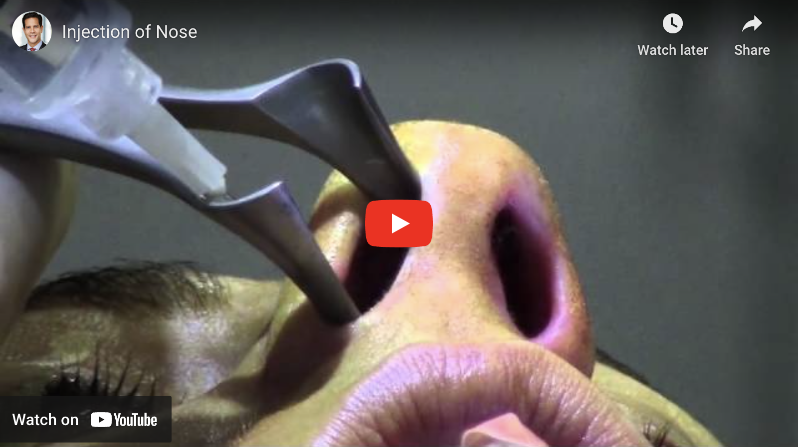 Injection of the Nose (video)