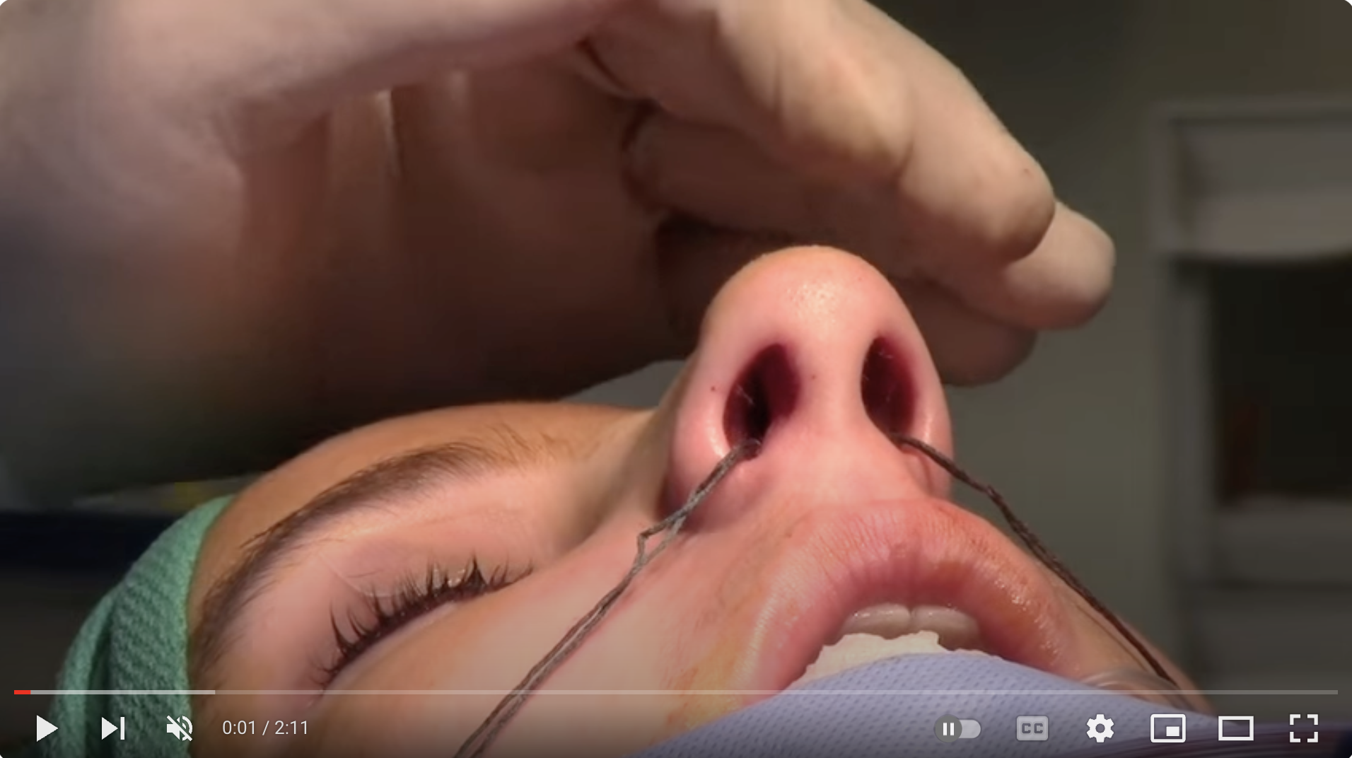 Rhinoplasty, Closed Approach, Incisions (video)
