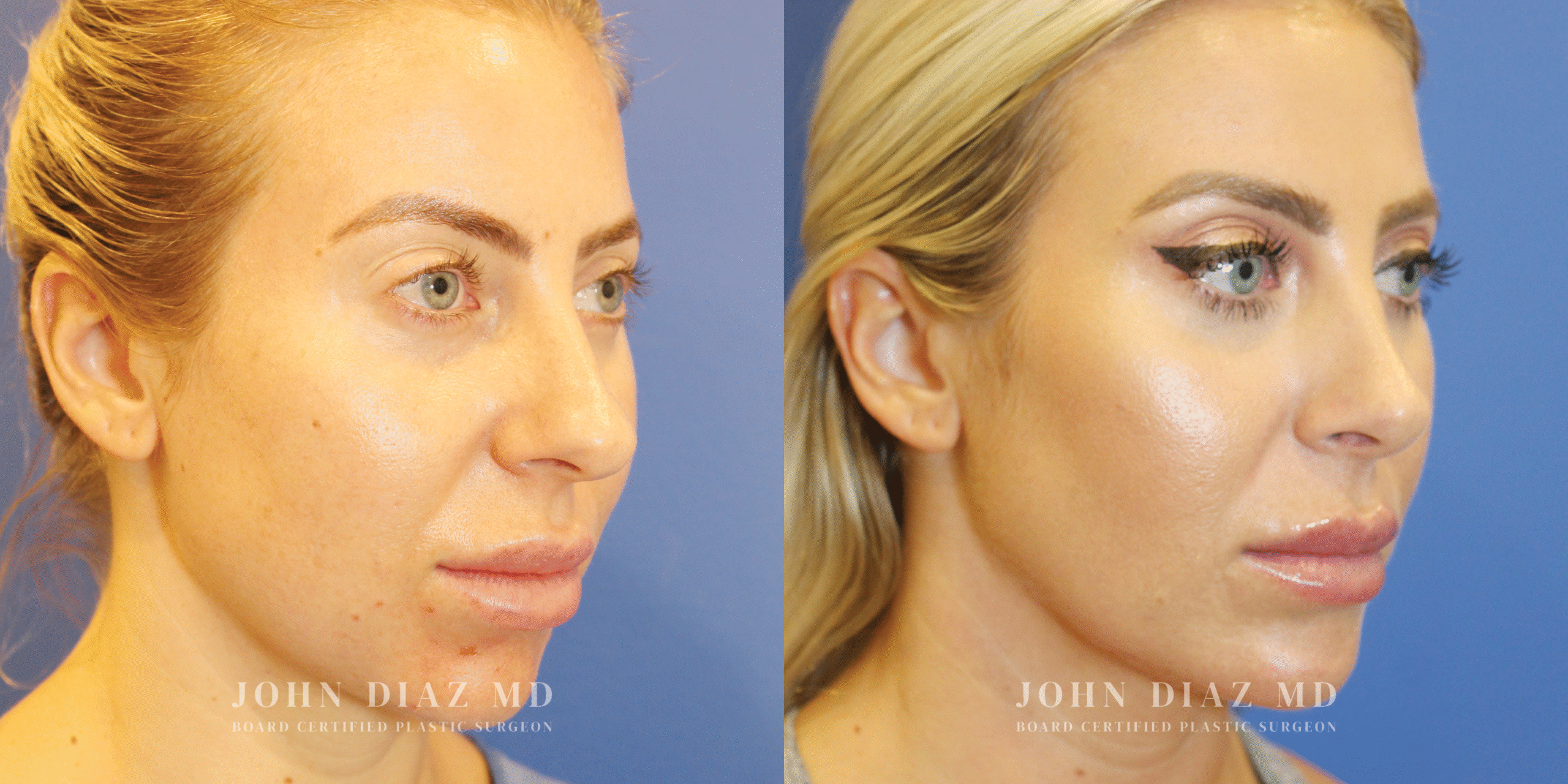 Dr John Diaz Buccal Lipectomy, Chin Augmentation, Rhinoplasty on female under 40