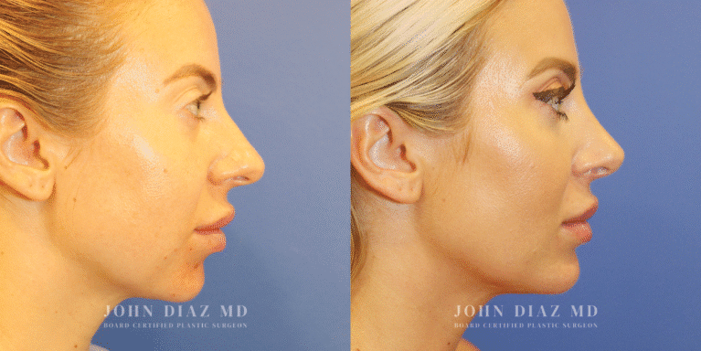 Dr John Diaz Buccal Lipectomy, Chin Augmentation, Rhinoplasty on female under 40