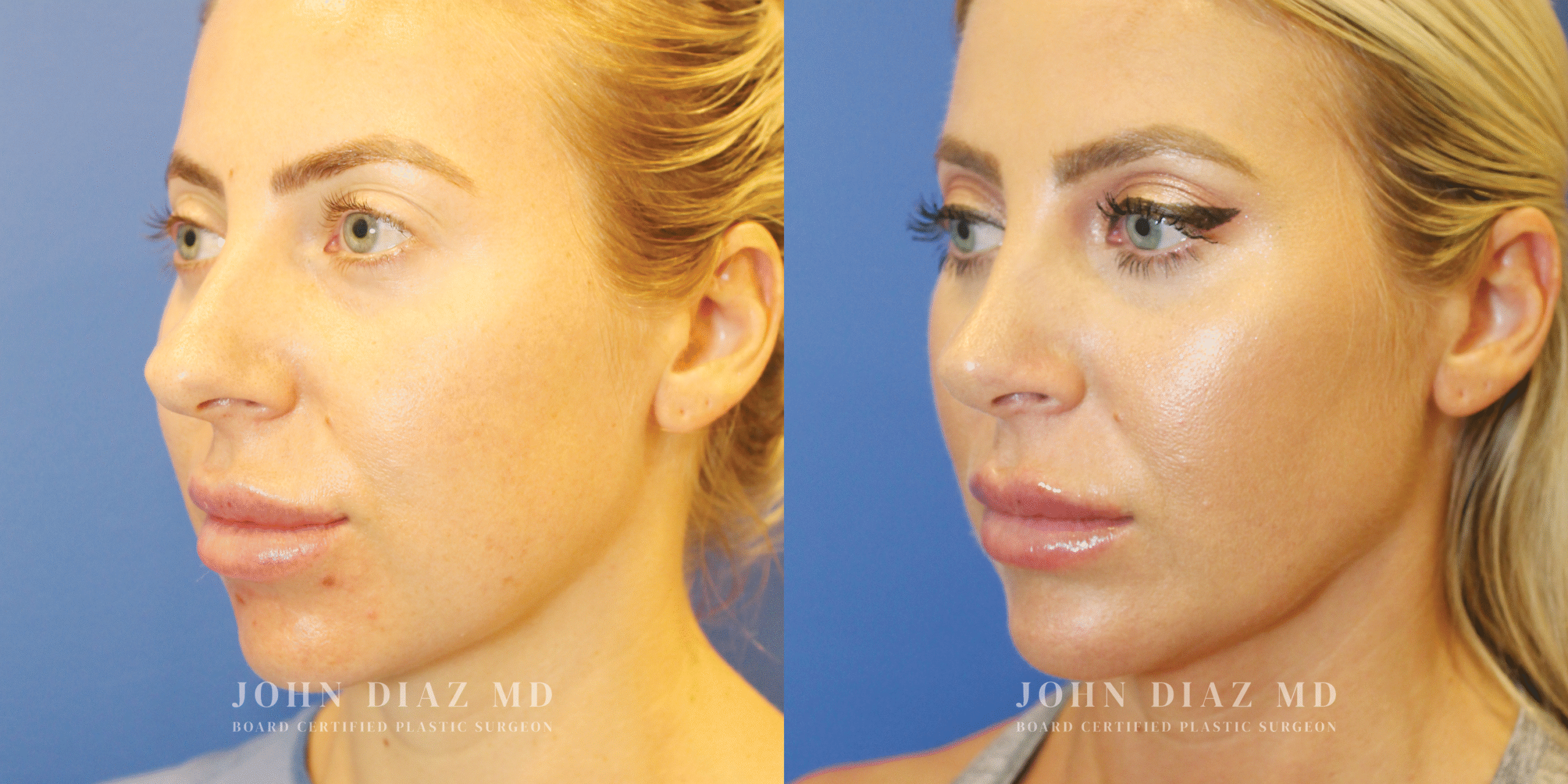 Dr John Diaz Buccal Lipectomy, Chin Augmentation, Rhinoplasty on female under 40
