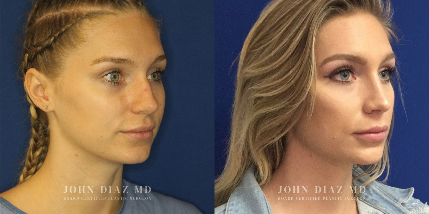 Dr John Diaz Rhinoplasty on female under 40