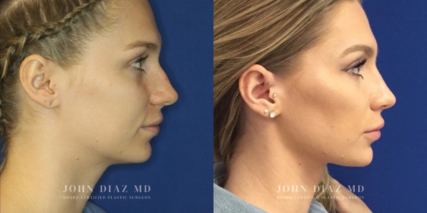Dr John Diaz Rhinoplasty on female under 40