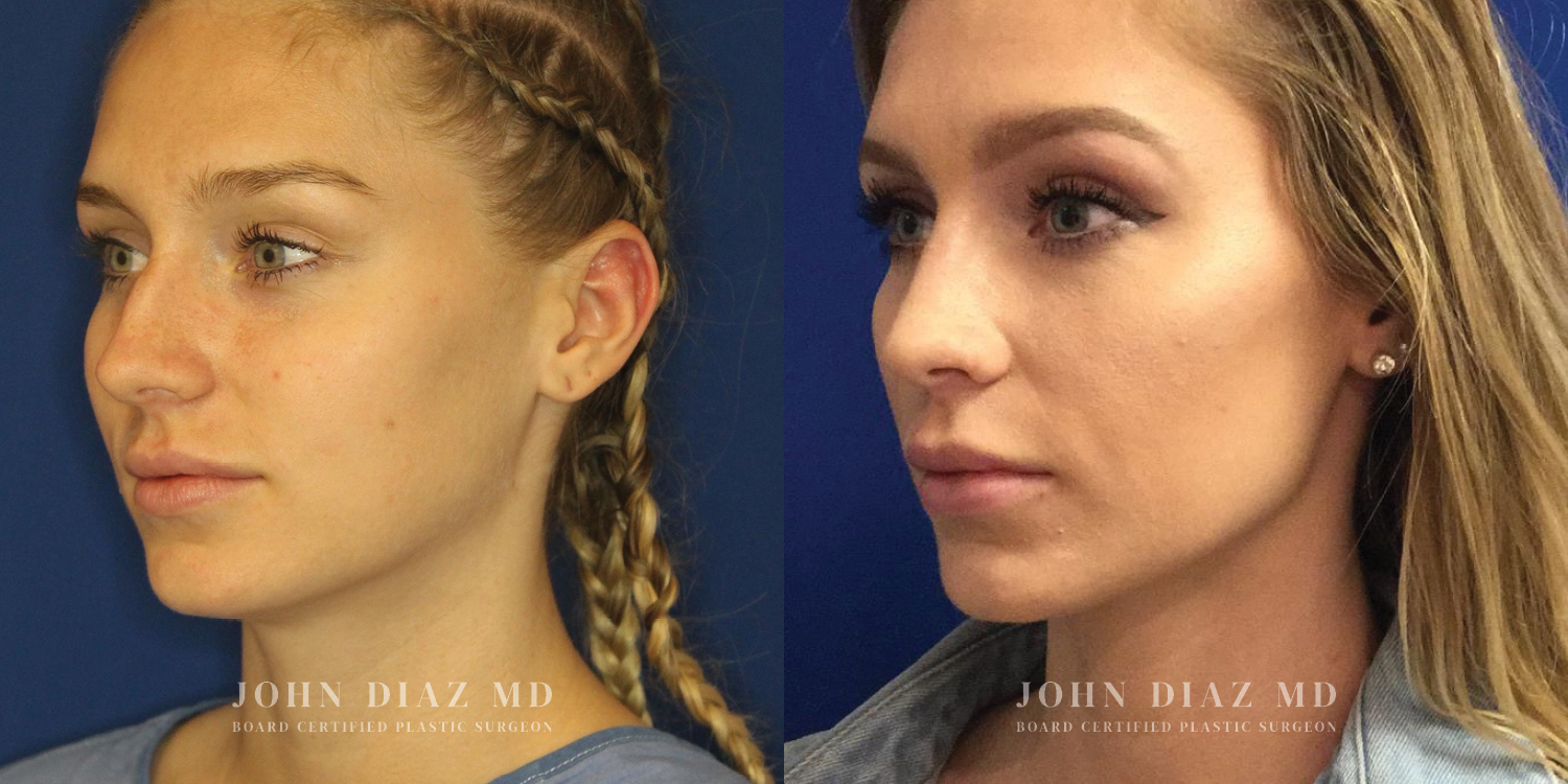 Dr John Diaz Rhinoplasty on female under 40