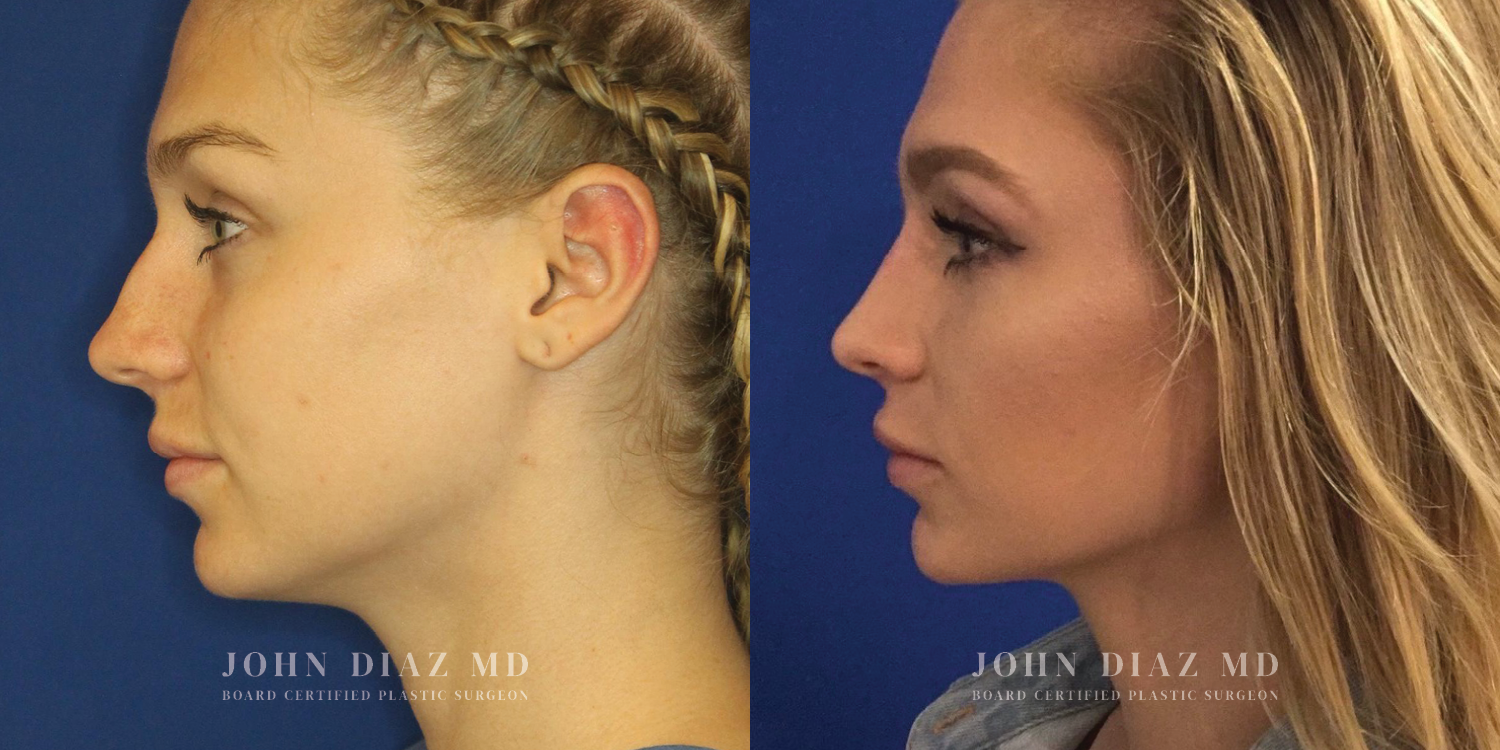 Dr John Diaz Rhinoplasty on female under 40