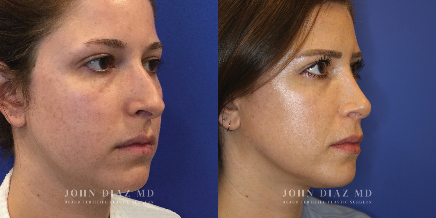 Dr John Diaz Rhinoplasty on female under 40