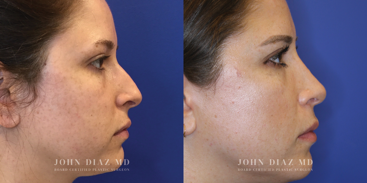 Dr John Diaz Rhinoplasty on female under 40