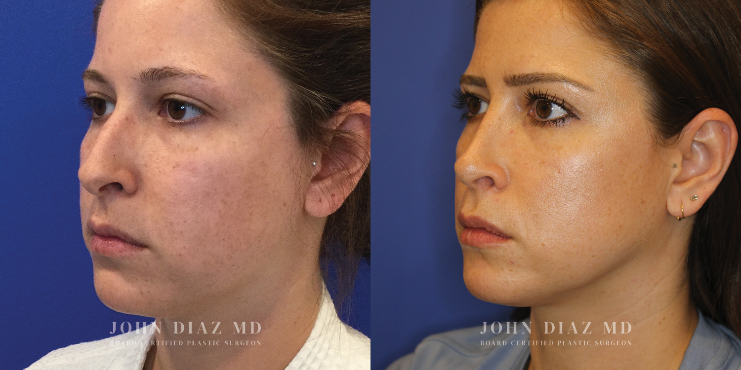 Dr John Diaz Rhinoplasty on female under 40