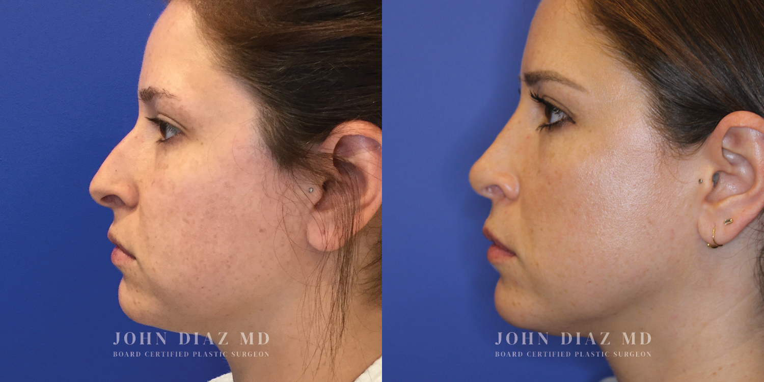 Dr John Diaz Rhinoplasty on female under 40