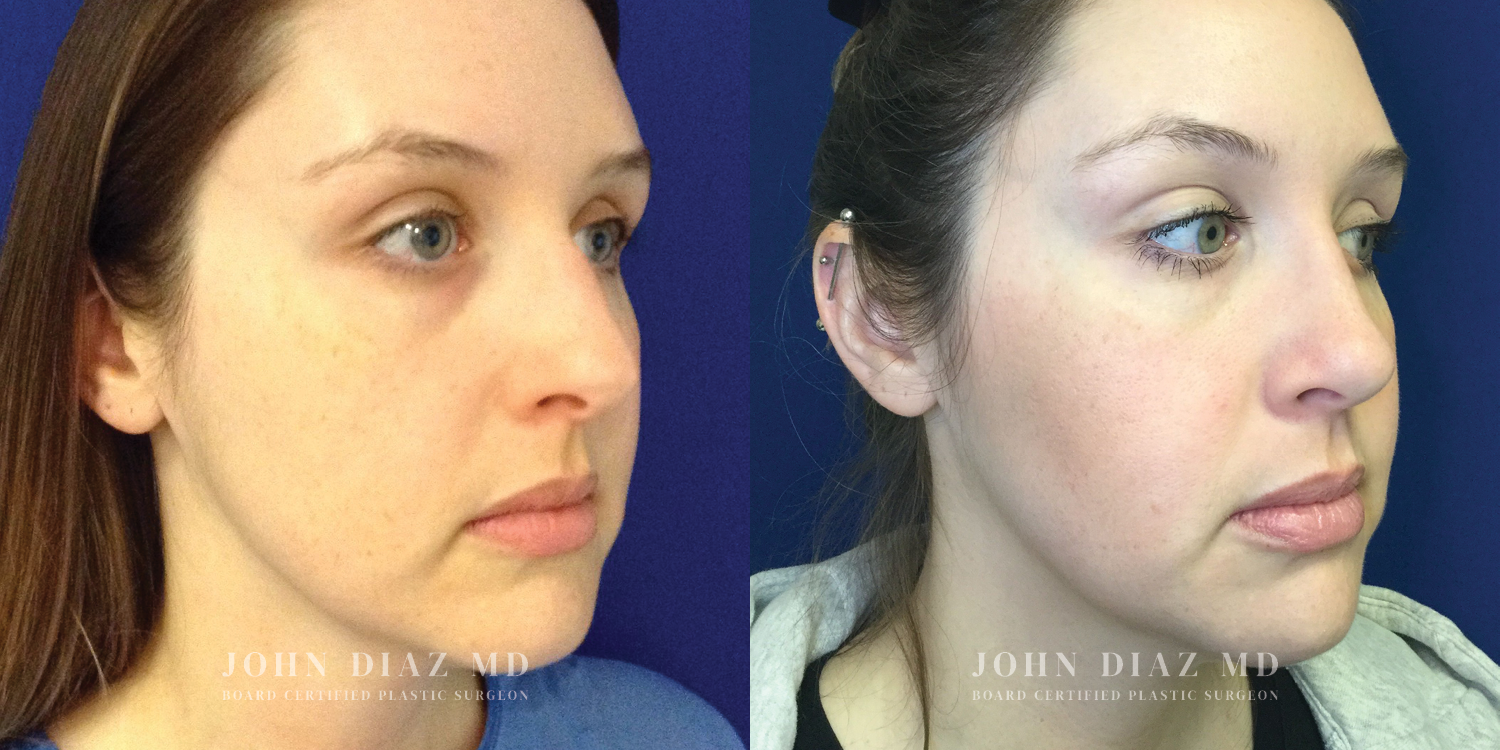 Dr John Diaz Rhinoplasty on female under 40