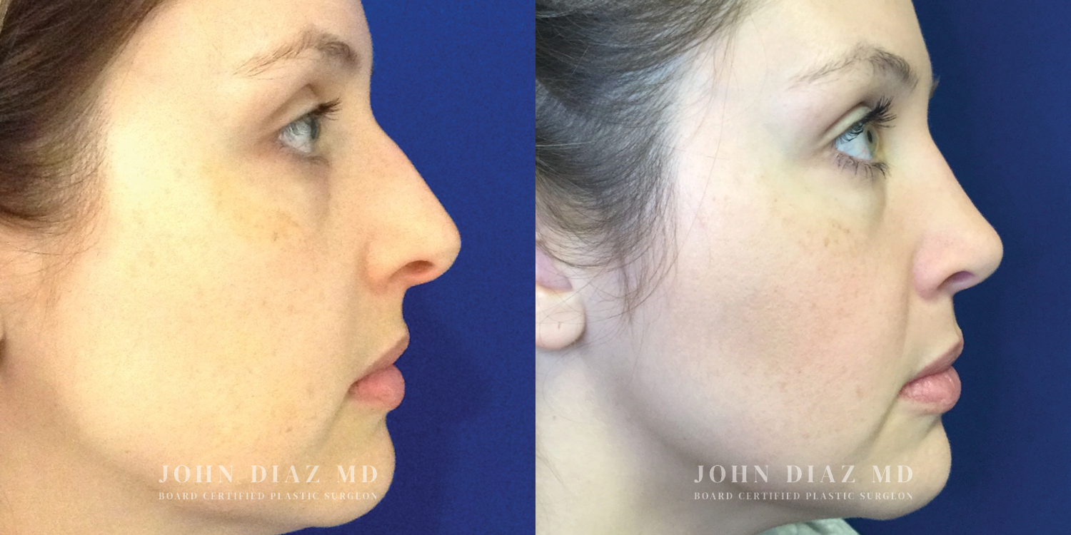 Dr John Diaz Rhinoplasty on female under 40