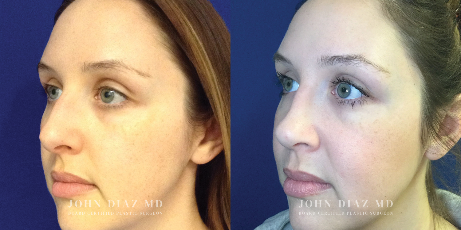 Dr John Diaz Rhinoplasty on female under 40