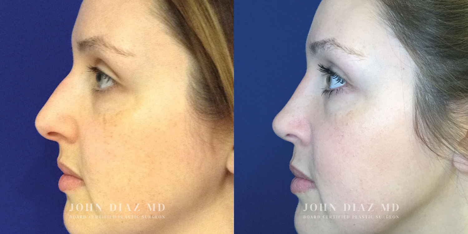 Dr John Diaz Rhinoplasty on female under 40