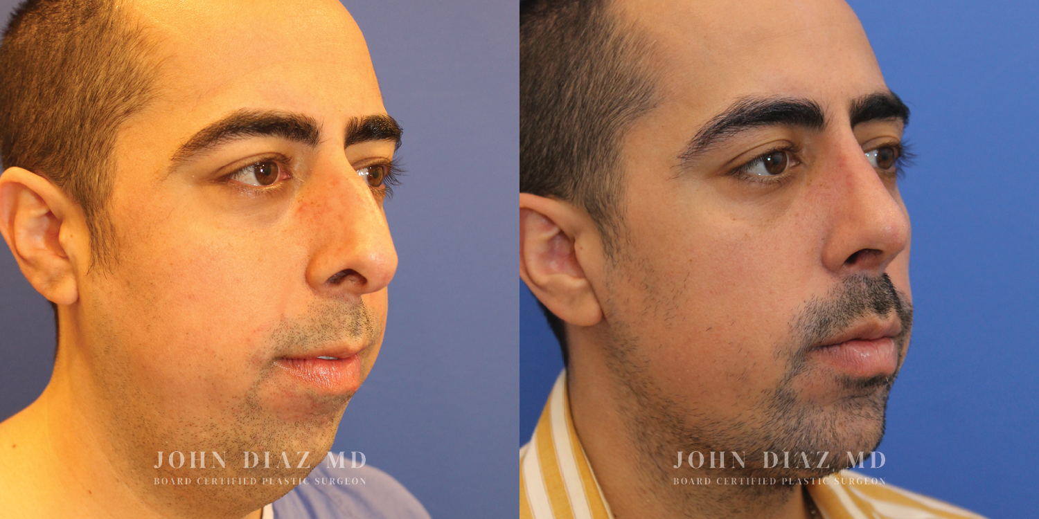 Dr John Diaz Rhinoplasty on male over 40