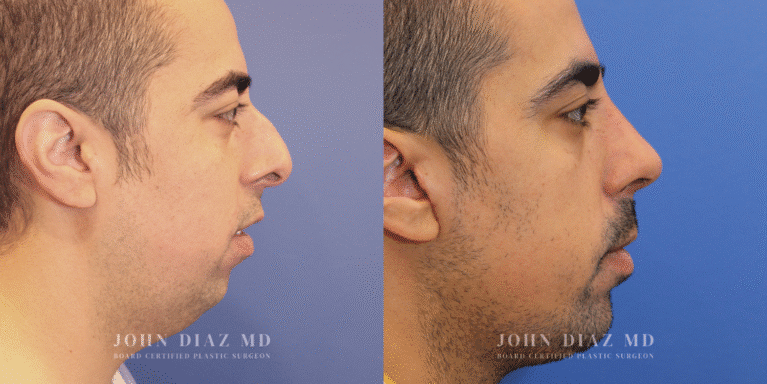 Dr John Diaz Rhinoplasty on male over 40