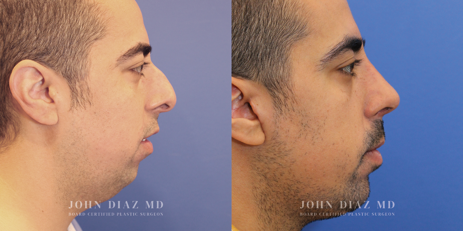 Dr John Diaz Rhinoplasty on male over 40