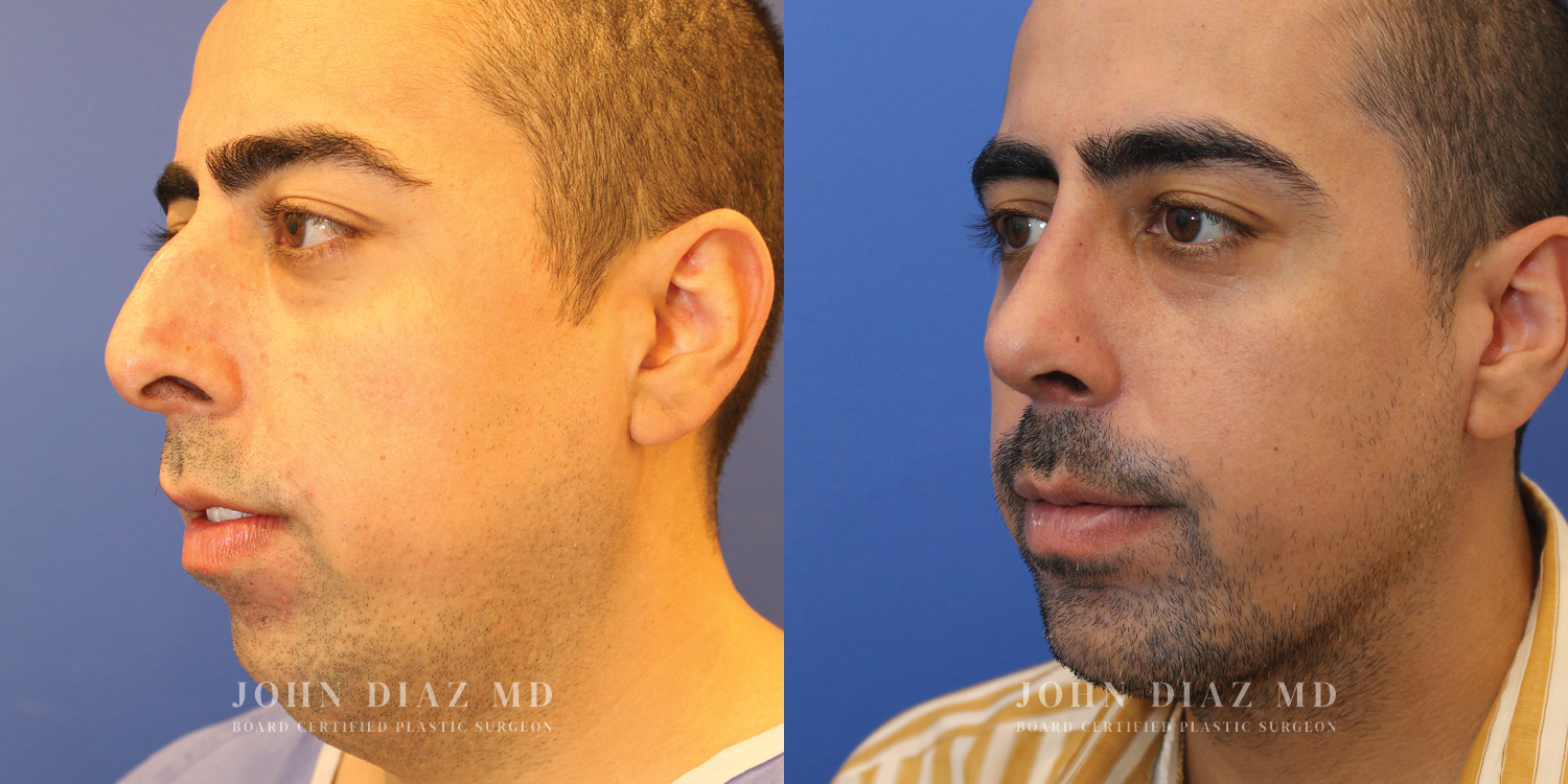 Dr John Diaz Rhinoplasty on male over 40