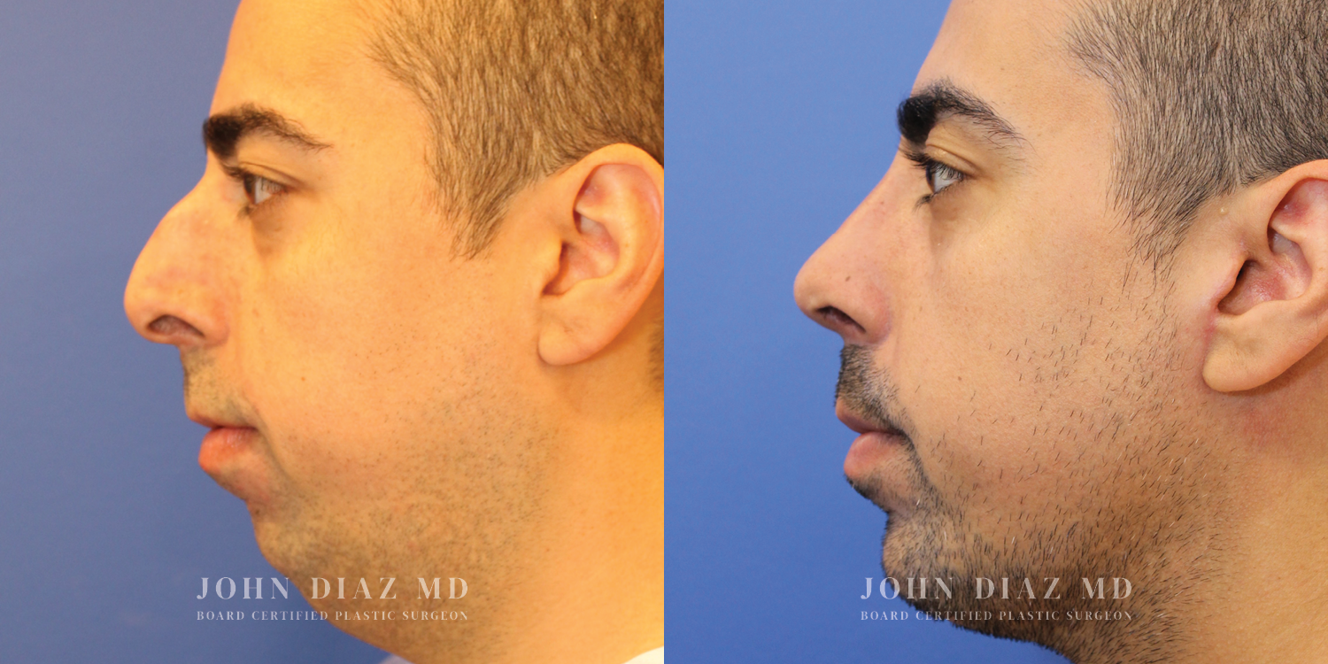 Dr John Diaz Rhinoplasty on male over 40