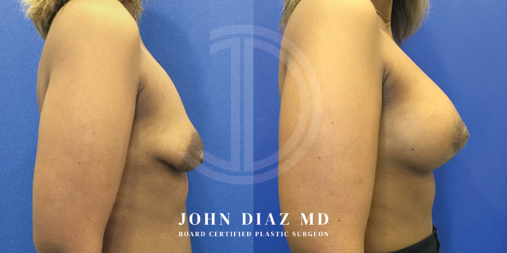 Dr John Diaz Breast Augmentation with Lift (Mastopexy)