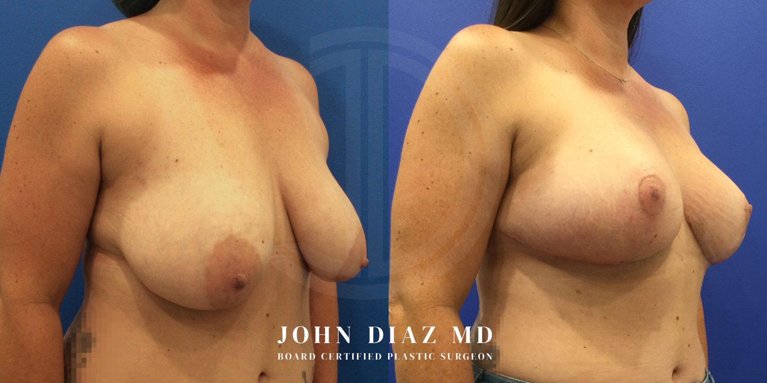 Dr John Diaz breast augmentation