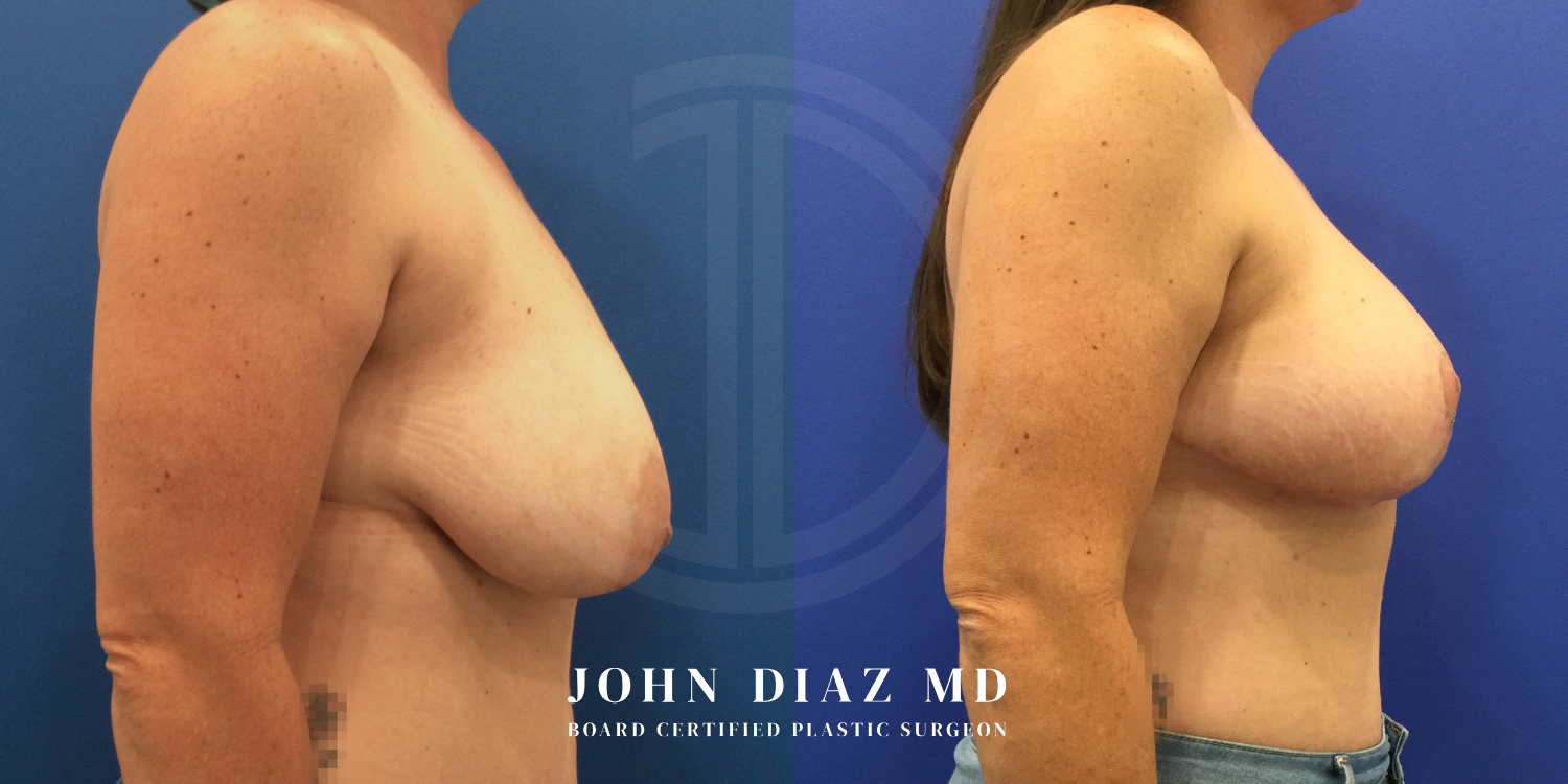 Dr John Diaz breast augmentation