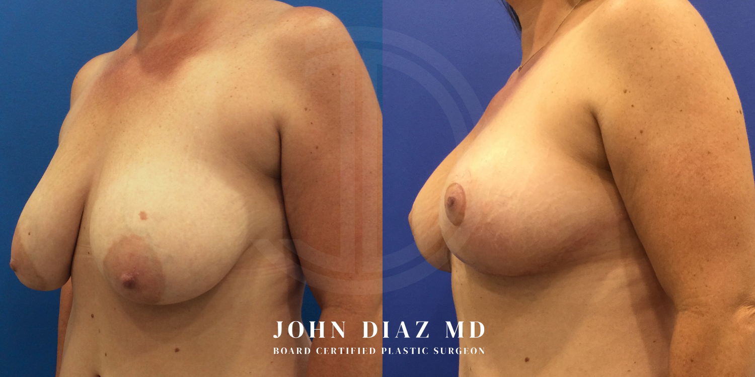 Dr John Diaz breast augmentation