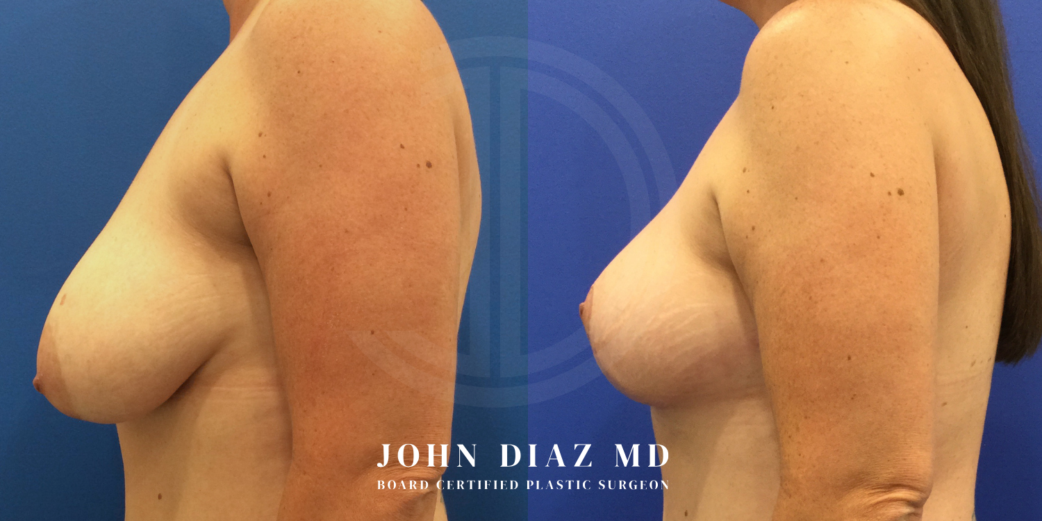 Dr John Diaz breast augmentation