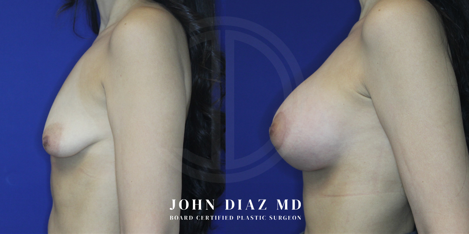 Dr John Diaz breast augmentation