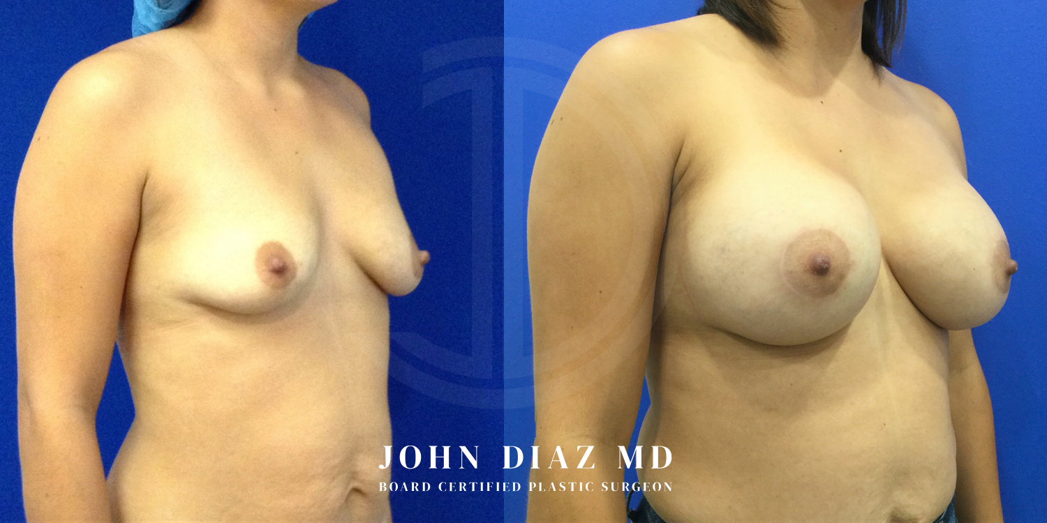 Dr John Diaz breast augmentation