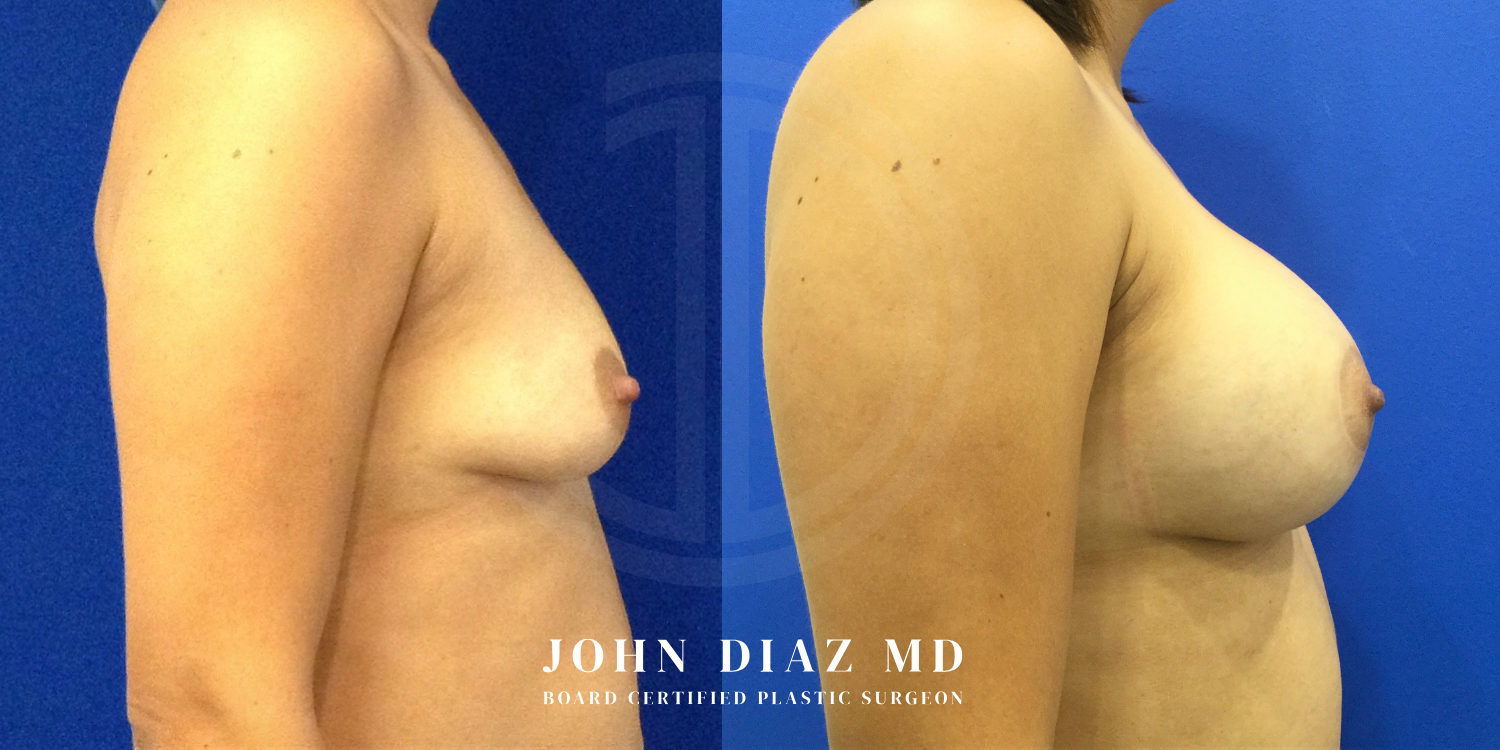 Dr John Diaz breast augmentation