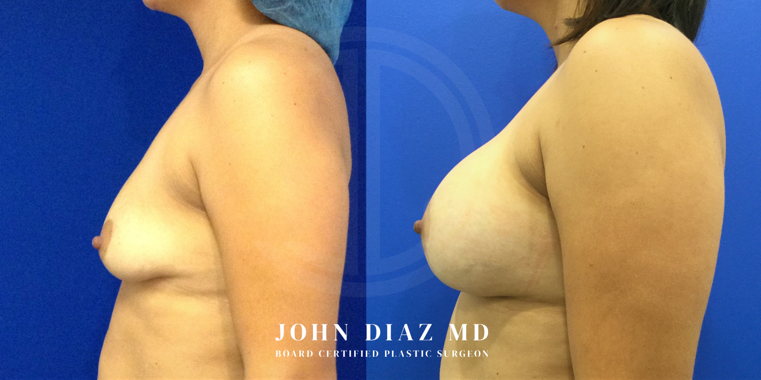 Dr John Diaz breast augmentation