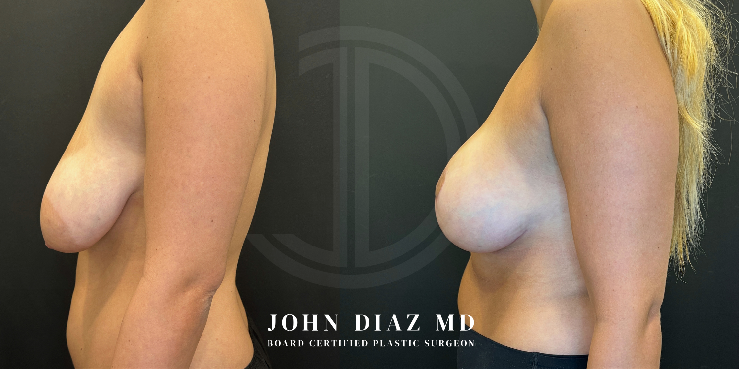 Dr John Diaz breast augmentation