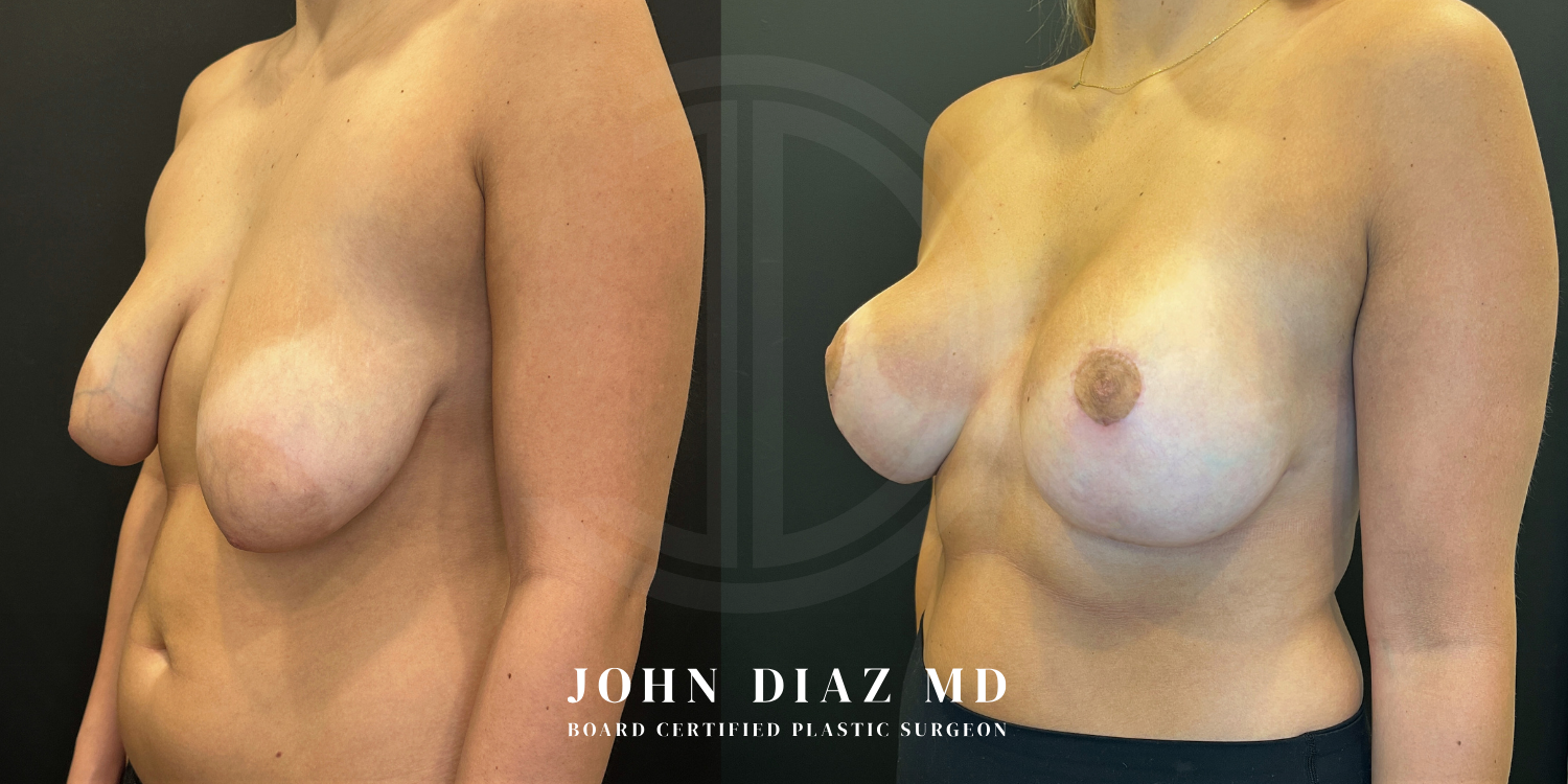 Dr John Diaz breast augmentation