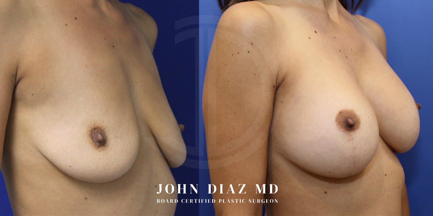 Dr John Diaz breast augmentation