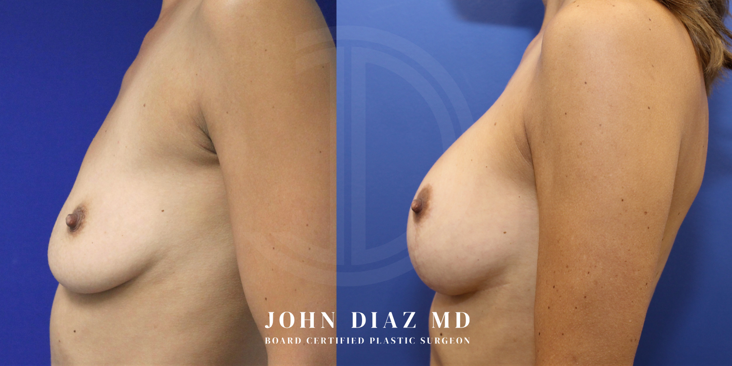 Dr John Diaz breast augmentation