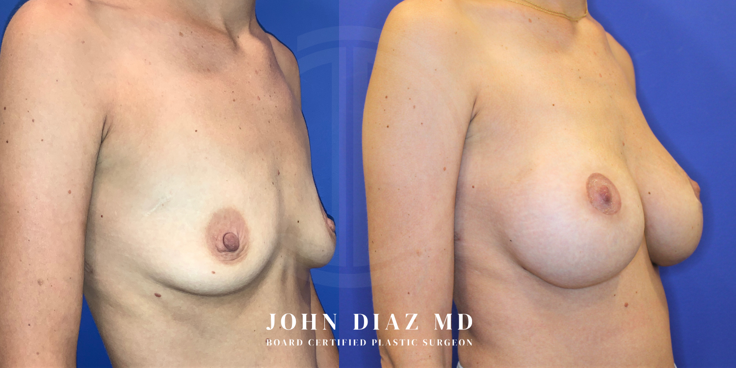 Dr John Diaz breast augmentation