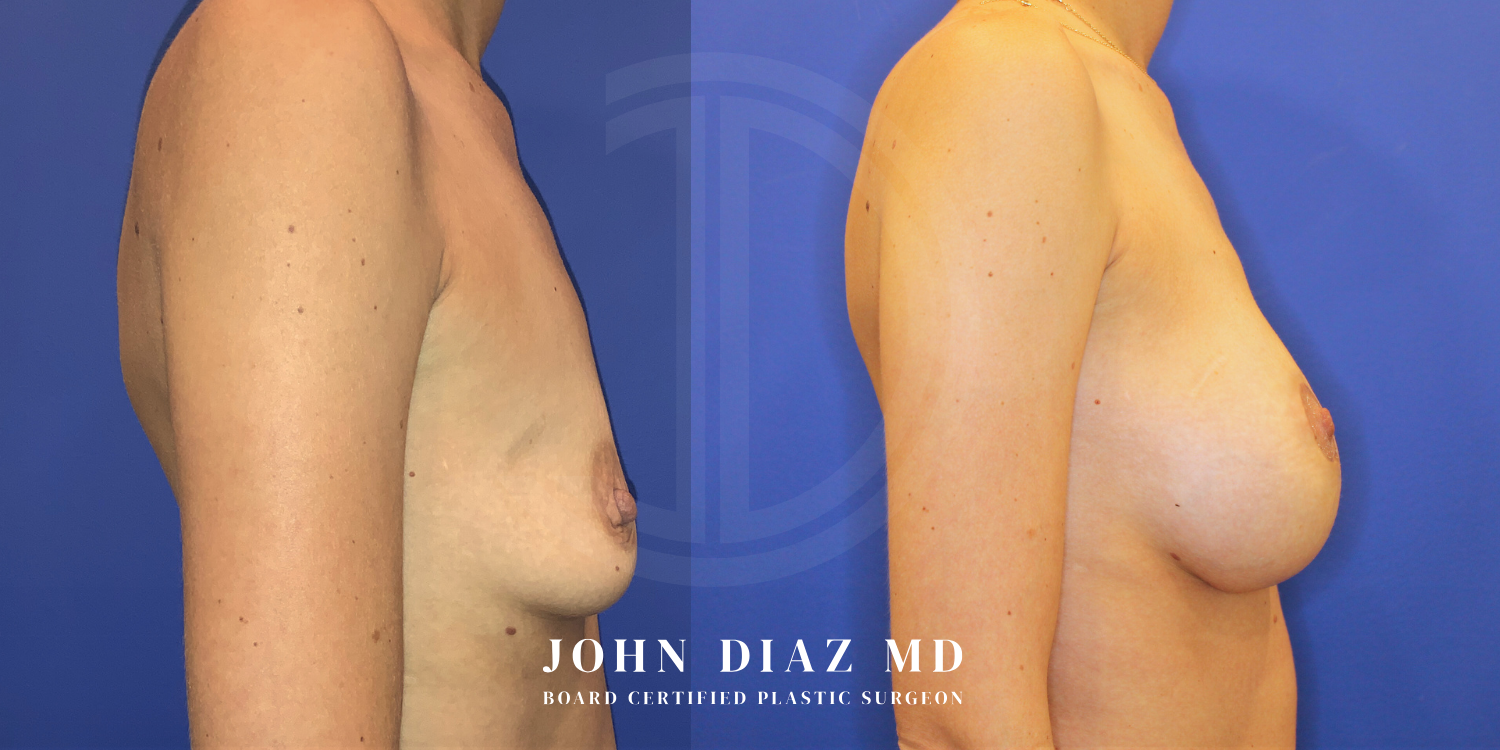 Dr John Diaz breast augmentation