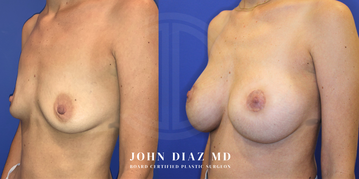 Dr John Diaz breast augmentation