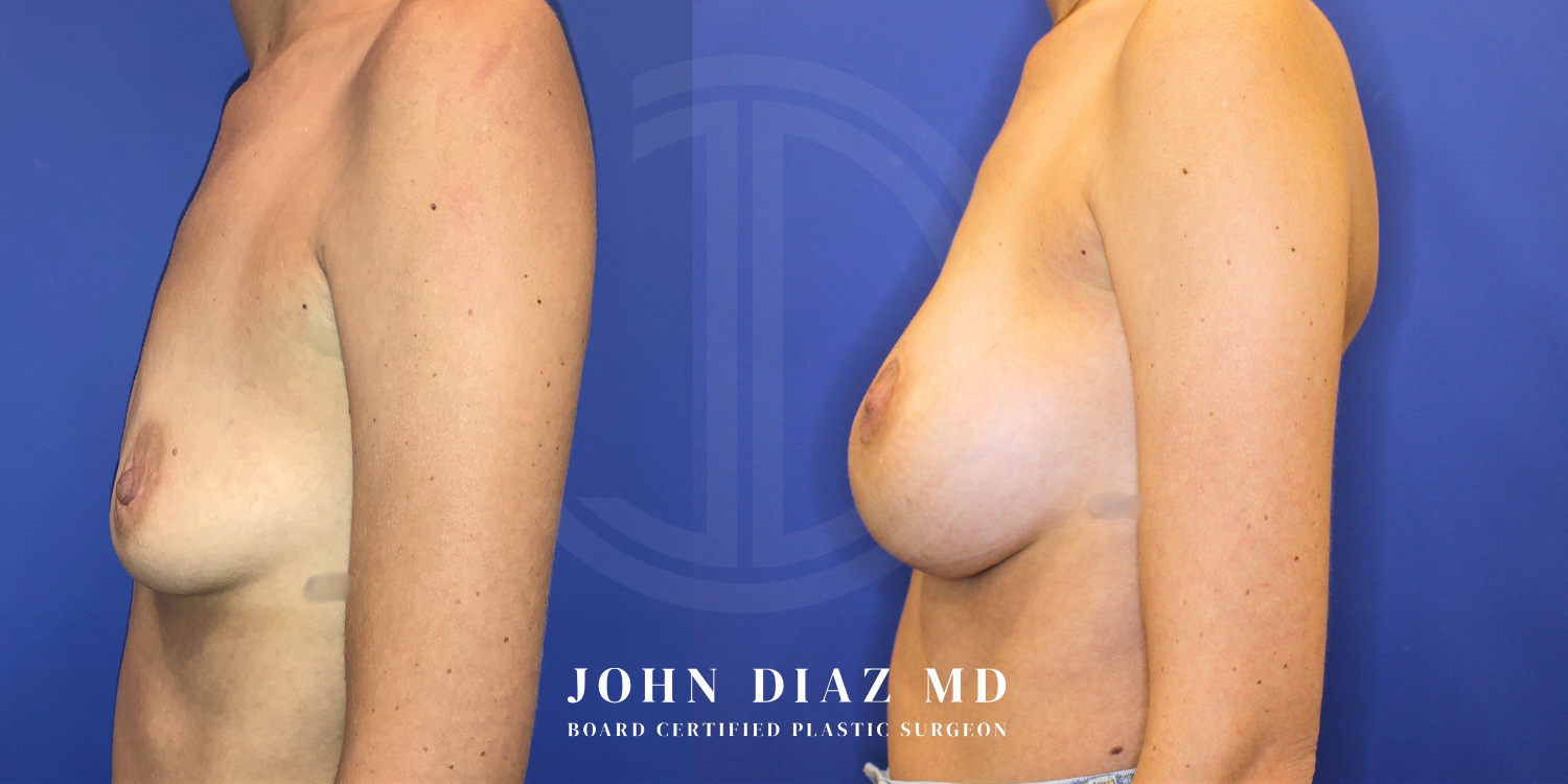 Dr John Diaz breast augmentation