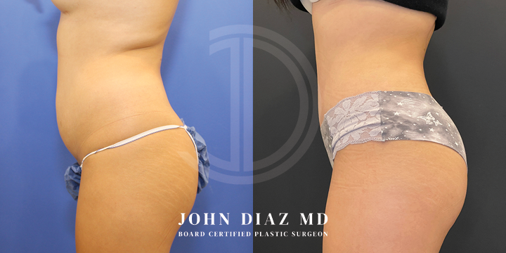 Dr John Diaz tummy tuck