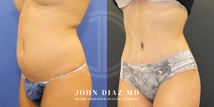 Dr John Diaz tummy tuck